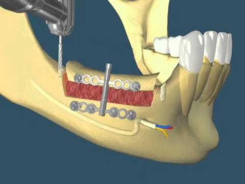 Tecnologia na cirurgia bucomaxilofacial Tecnologia na cirurgia bucomaxilofacial