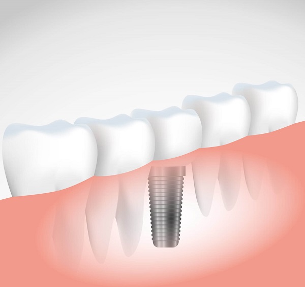 Entenda o que faz um cirurgião bucomaxilofacial Entenda o que faz um cirurgião bucomaxilofacial